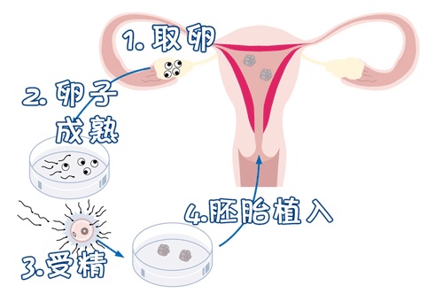 42岁二胎案例